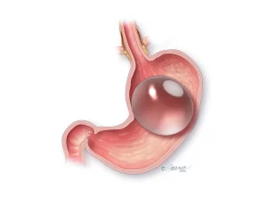 obera gastric balloon